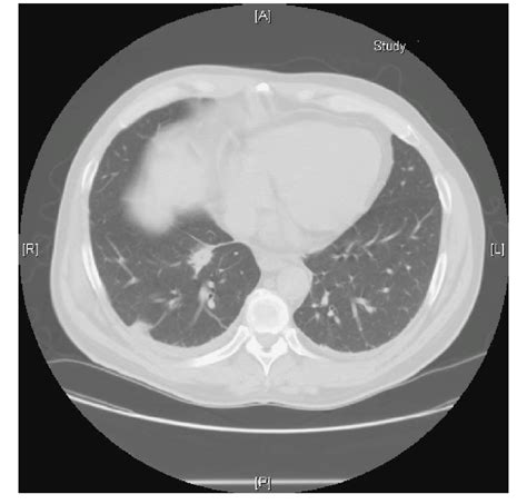 CT scan of the chest without contrast done on day 15 after... | Download Scientific Diagram