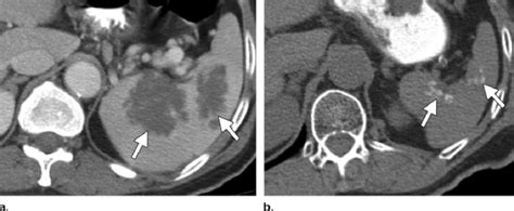 Normal splenic changes due to therapeutic irradiation in a 64-year-old... | Download Scientific ...