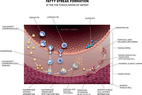 Fatty Streak Formation In The Artery Stock Illustration - Download Image Now - iStock