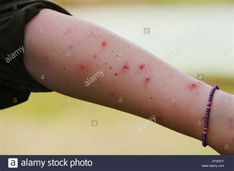 Mosquito Bites High Resolution Stock Photography and Images - Alamy