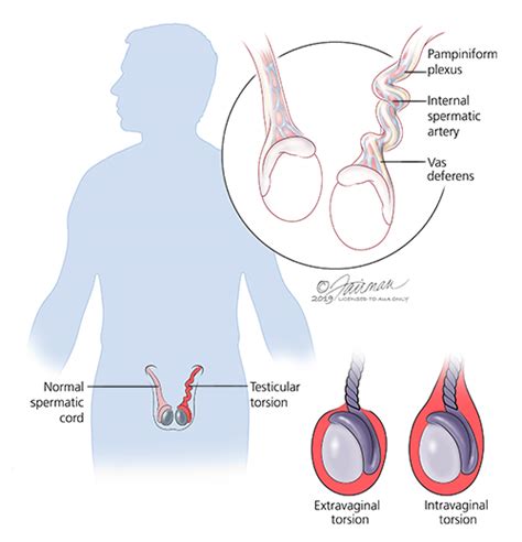 Testicular Torsion Treatment