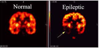 Brain Surgery For Epilepsy - Home