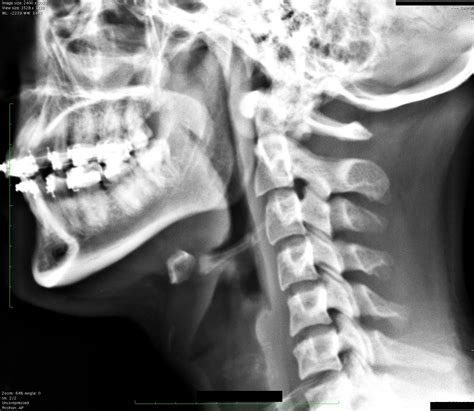 Broken Hyoid Bone