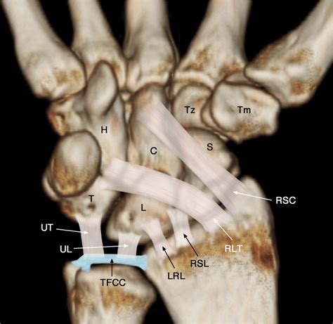 Schematic diagram of volar extrinsic wrist ligaments. RSC volar ...