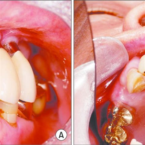 Exposed necrotic bone after tooth extractions in a patient treated with ...