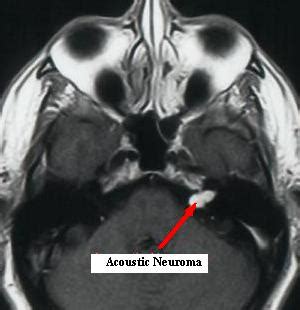 Acoustic neuroma (vestibular schwannoma) information | myVMC