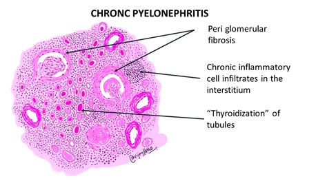 CHRONIC PYELONEPHRITIS - Pathology Made Simple