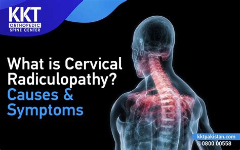 What is Cervical Radiculopathy? Causes and Symptoms - KKT Pakistan | Pakistan's Only Non ...