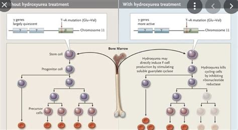 Hydroxyurea Sickle Cell Anemia!