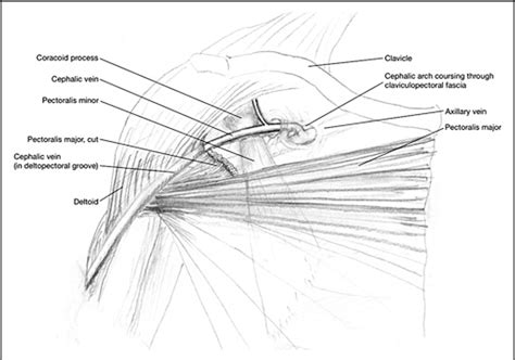 Cephalic Arch Stenosis in Dialysis Patients: Review of Clinical Relevance, Anatomy, Current ...