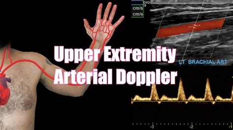 Arterial Duplex/Doppler Sonography of the Upper Extremities – Sonographic Tendencies