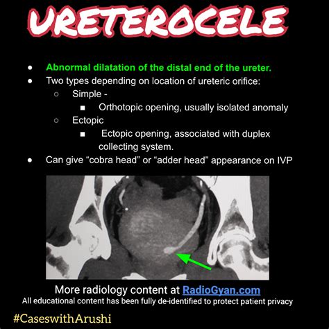 Ureterocele in 2022 | Abnormal, Radiology, Bladder