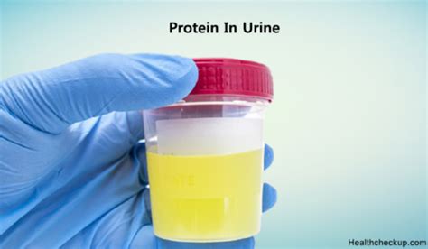 Protein in Urine Normal, Low, High Ranges | Signs,Types of Proteinuria