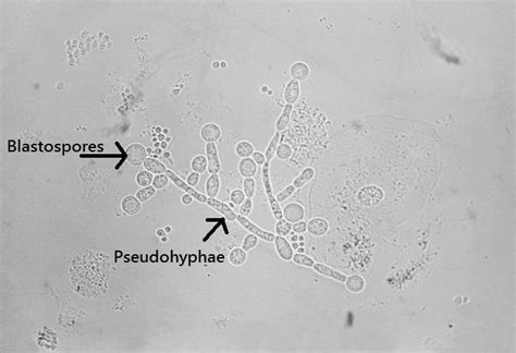 Esophageal candidiasis laboratory findings - wikidoc