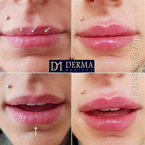 DIFFICULT LIPS This lovely client had some really bad experiences with ...