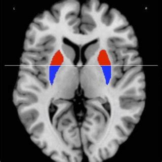 Axial view of the division of left and right putamen in anterior and ...