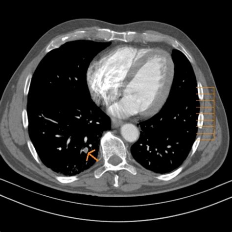 Subsegmental acute pulmonary embolism with right ventricular overload | Eurorad