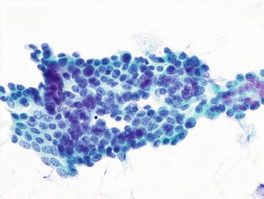 Atypical Urothelial Cells (AUC) | Basicmedical Key