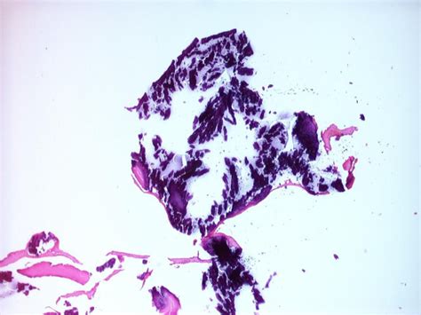 Heavy calcified tissue fragment, approximately 1.5 mm diameter (H&E,... | Download Scientific ...