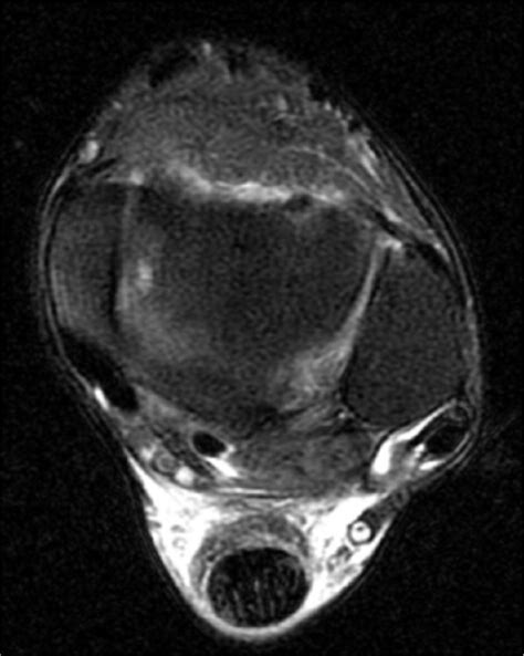 Distal hypointensity of the peroneus brevis tendon (MRI axial view). | Download Scientific Diagram