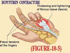 Dupuytren Contracture Treatment in Chennai | ID: 7622000562