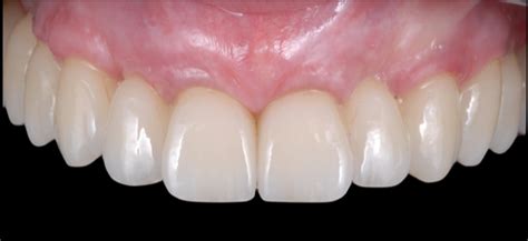 Edentulous Implant Solutions – From Patient to Treatment to Final ...