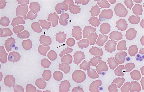 pyknocyte Archives | eClinpath