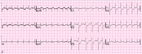 Dr. Smith's ECG Blog: Atrial Fibrillation w Rapid Ventricular Response and ST Depression Maximal ...