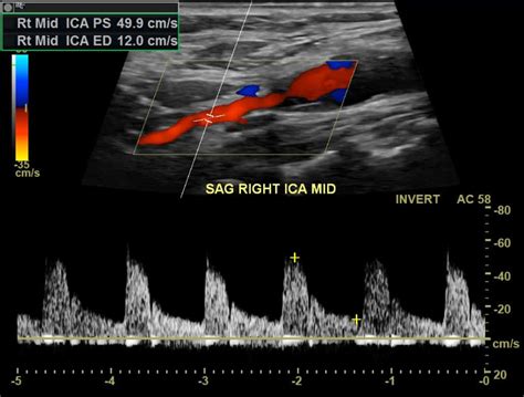 Carotid Dissection Causes, Diagnosis and Treatment