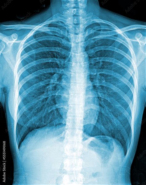 Bronchiectasis . X-ray chest show multiple lung bleb and cyst due to chronic infection 素材庫相片 ...