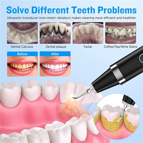 Ultrasonic Plaque Remover & Dental Cleaner Kit | 5 Modes for Calculus ...