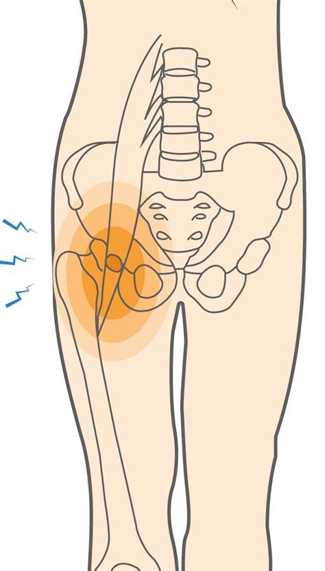 Iliopsoas Bursitis Injection