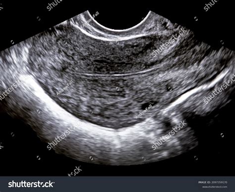 Normal Uterus Transvaginal Ultrasound