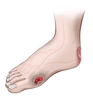 Foot Infections El Paso | Diabetic Foot Infections | Cellulitis El Paso