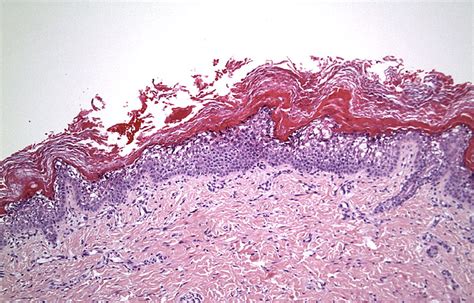 Histopathologic characterization of epidermolytic hyperkeratosis: A ...