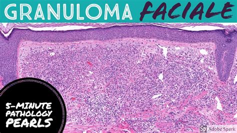 Granuloma Faciale: 5-Minute Pathology Pearls - YouTube