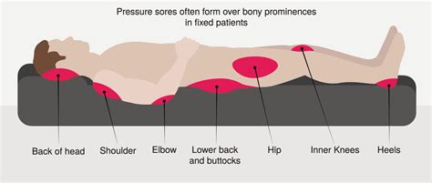 Pressure Injury 101: Stage 1 Pressure Ulcers