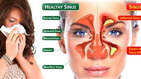 Sinus Pressure Points Diagram