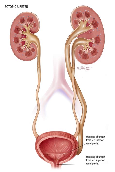 What is Ectopic Ureter? - Urology Care Foundation