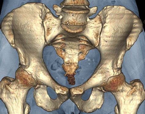 Healthy pelvis, 3D CT scan - Stock Image - C009/5448 - Science Photo Library