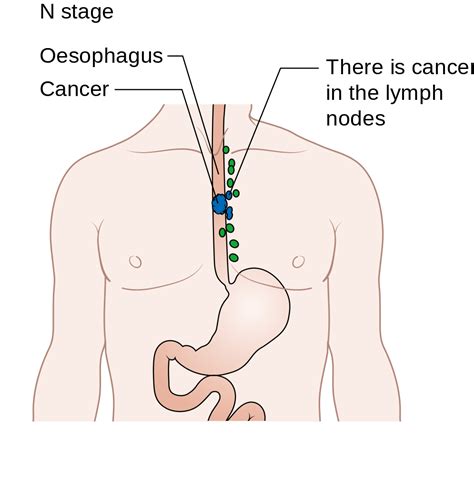 Barrett's Esophagus Receives New Treatment Options