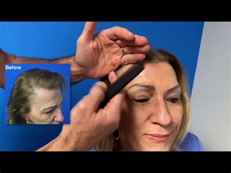 Female Hairline Restoration Case Study - Hair Restoration Center of CT ...