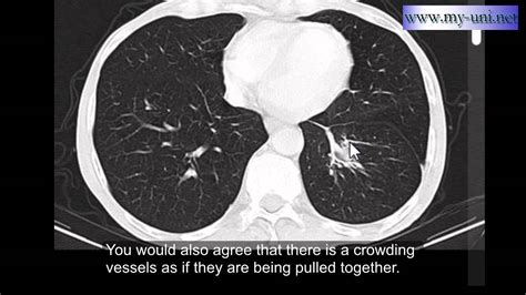 Rounded atelectasis - CT scan of Chest - YouTube