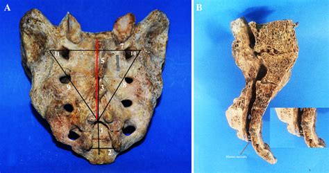 Anatomy of the sacral hiatus and its clinical relevance in caudal ...