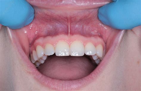 Hereditary Gingival Fibromatosis: Symptoms, Diagnosis and Treatment ...