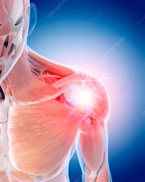 Shoulder pain - Stock Image - F016/2307 - Science Photo Library