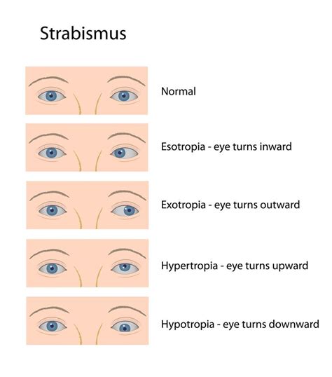 Types of Strabismus | Eye facts, Eye treatment, Medical illustration