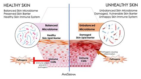 What is Skin Microbiome? | Microbiome, Skin health, Acne vulgaris