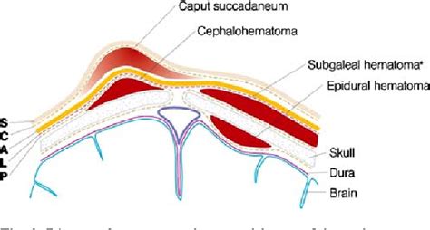 Subgaleal hematoma presenting as a manifestation of Factor XIII deficiency | Semantic Scholar