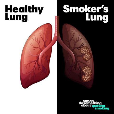 Smokers lungs before/ after quitting smoking | Comparison of… | Flickr